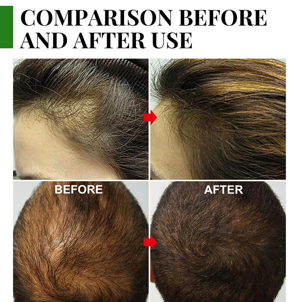 US 2-4 Pcs Rosemary Essential Oil Hair Growth 100% Pure Natural Therapeutic