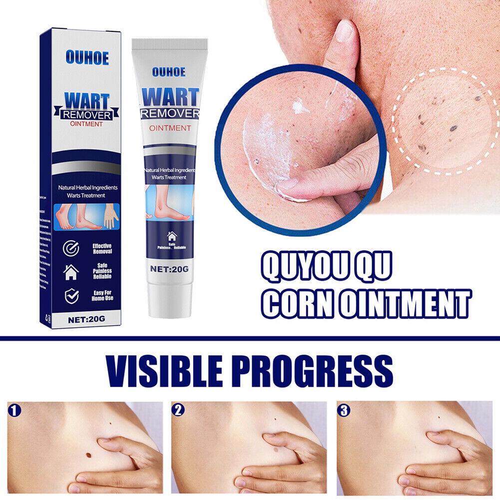 US 2-4 Pack Wart Skin Remover Cream Antibacterial Extract Corn Plaster Ointment