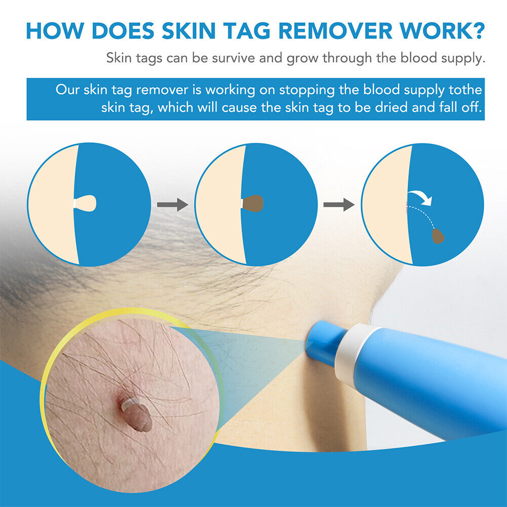 US 1-2 Pcs Auto Micro Skin Tag Remover Device Kit Safe Painless Removal Set Tool