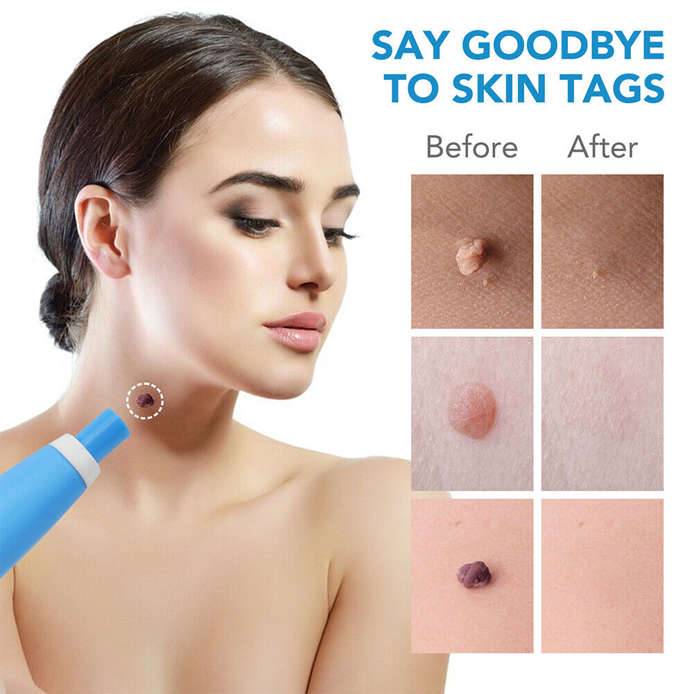 US 1-2 Pcs Auto Micro Skin Tag Remover Device Kit Safe Painless Removal Set Tool
