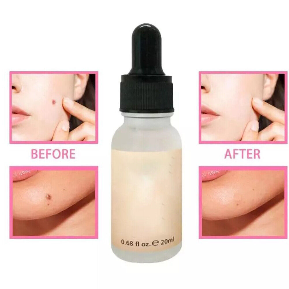 US 2-4 Pcs Serum Mole Skin Tag Dark Spots Warts Remover Serum Dark Spot Remover