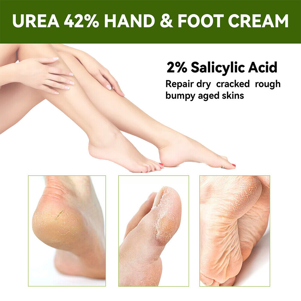 US 1-2 Pc Hand Cream 42%Urea Salicylic Acid Deep Moisturizing Softening Skin
